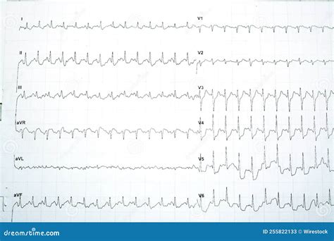 Electrocardiogram Test Results For Myocardial Ischemia Diagnosis Stock Image Image Of