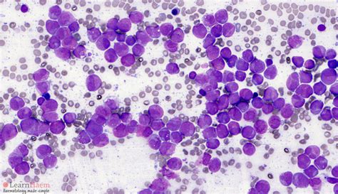 Acute Promyelocytic Leukemia Microgranular Variant