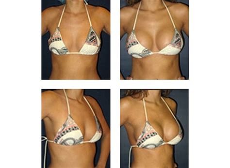 Rapid Recovery Breast Augmentation By Dr Matthew Schulman Nyc Board