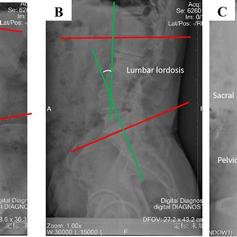 Measuring Method Of Cobb Angle A Lumbar Lordosis B And Sacral