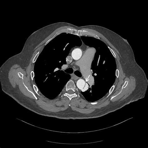 Aortic Dissection Cardiovascular Disorders Msd Manual Professional