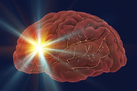 Concepto Del Movimiento Del Cerebro Foto De Archivo Imagen De Vena Doloroso 111511258