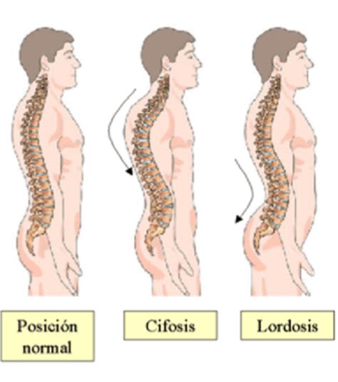 Correcci N Cifosis Y Lordosis