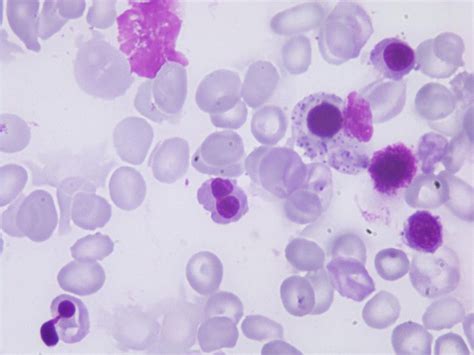 refractory anaemia  ring sideroblasts rars