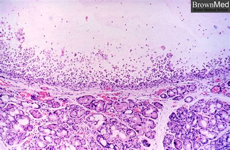 Mucous Retention Cyst Lip Pathology Outlines | Sitelip.org