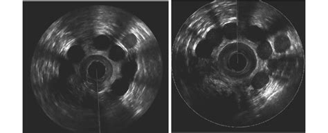 A 3D Anal Endosonography 1 Month Postoperatively 6 Prostheses In The