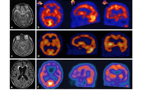 A Patient 1 MRI T2 Weighted Image Showing Mild Cortical Atrophy More