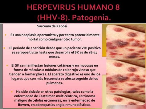 Herpesvirus Humano Y Ppt