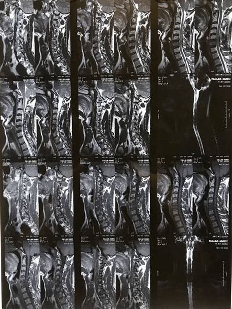 Cervical Spine Mri Shows An Epidural Abscess At The C5‐c6 Levels