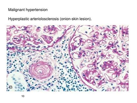 Ppt Benign Nephrosclerosis Powerpoint Presentation Free Download