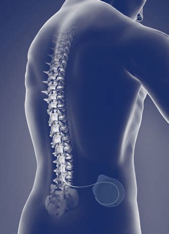 Intrathecal Pump Implantation To Treat Pain Pegasus Pain Management