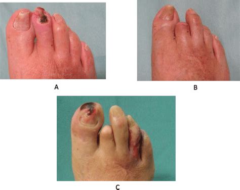 Case 2 Ischemic Ulcer Pad A The Photograph Shows A Necrotic Wound Download Scientific