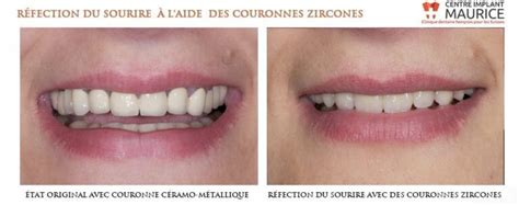 Couronne Zircone Ou C Ramique I Centre Implant Maurice