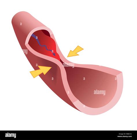 Occluded Artery