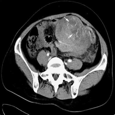 Preoperative Computed Tomography Ct Scan Of The Mesenteric Mass Download Scientific Diagram