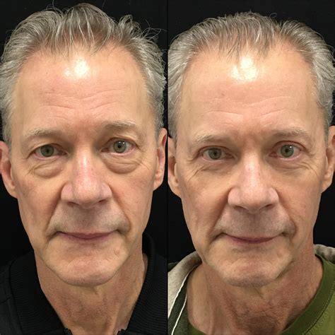 Patient Upper Lower Blepharoplasty With Fat Transfer