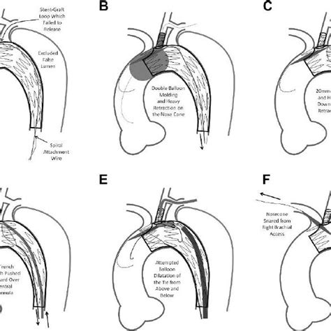 A C The Proximal Component Of The Custom Made Fenestrated Download Scientific Diagram