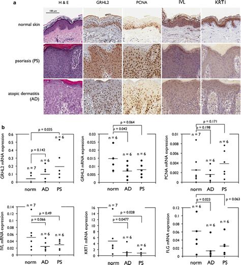 Grhl2 Level Is Enhanced In Hyperproliferative Diseases Of The Skin A Download Scientific