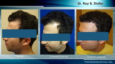 Follicular Unit Extraction Hair Transplant Hair Transplant Nyc Hair Transplants New York City