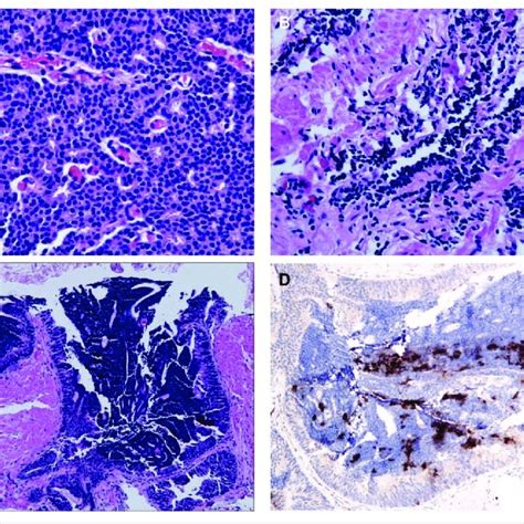 The Needle Core Biopsies Of Prostate Show A Mixed Morphologic Pattern