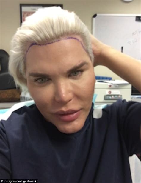 Human Ken Doll Rodrigo Alves Has £19k Hair Transplant Daily Mail Online