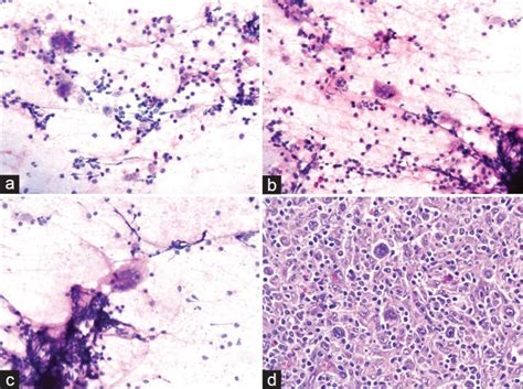 A C Cytology Smear Shows Binucleated Reedsternberg Cells And Download Scientific Diagram