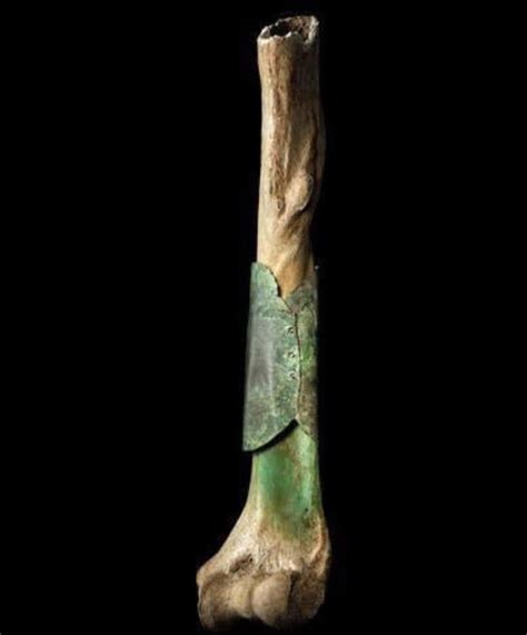 A Medieval Surgeon Repaired This Broken Bone With Riveted Copper New