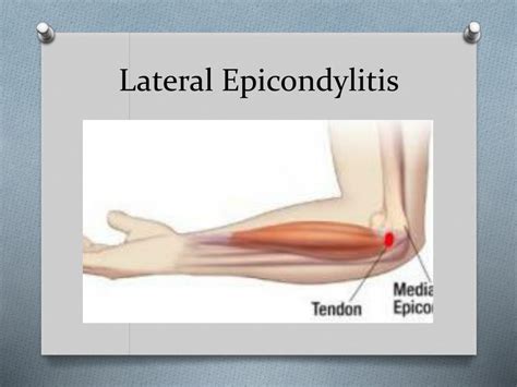 Ppt Elbow Injuries Powerpoint Presentation Free Download Id2188505