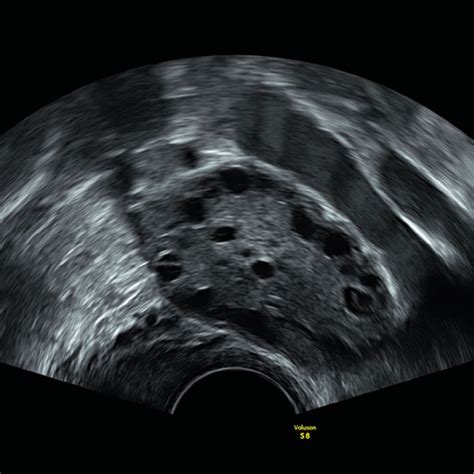 Sonografische Beurteilung Der Fertilit T Gyn Kologie Geburtshilfe