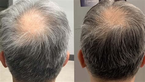 Alma TED Is the New Non-Invasive Hair Loss Solution on the Market