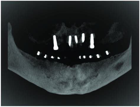 Reformatted Panoramic View On Cbct For Edentulous Mandibular Ridge With