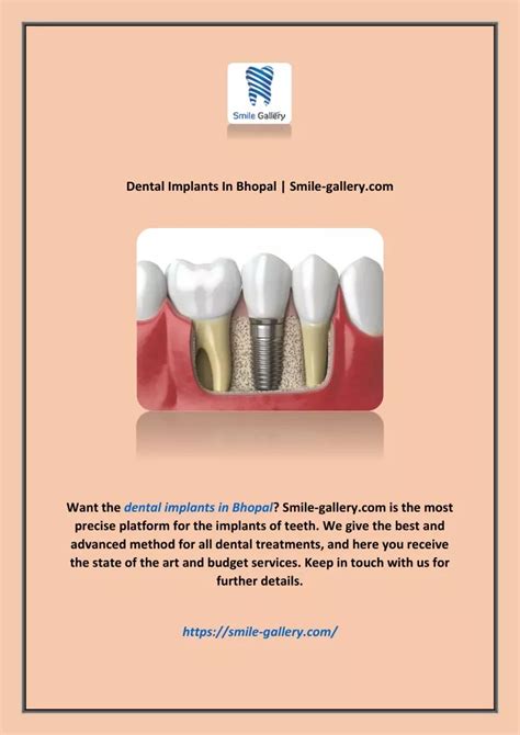 Ppt Dental Implants In Bhopal Smile Gallery Powerpoint