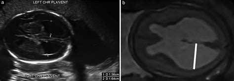 Fetal Hydrocephalus Ultrasound