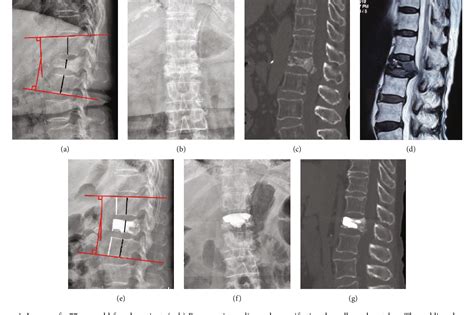 Figure From Comparison Between Percutaneous Kyphoplasty And Posterior