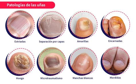 Anatom A Y Patolog As De Las U As Enfermedades En Las U As Salud De