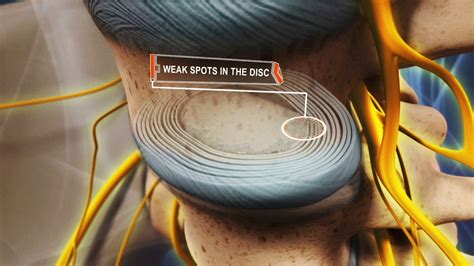 What's a Herniated Disc, Pinched Nerve, Bulging Disc...? | Spine-health