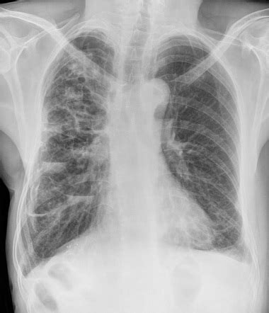 Bronchiectasis | Radiology Reference Article | Radiopaedia.org