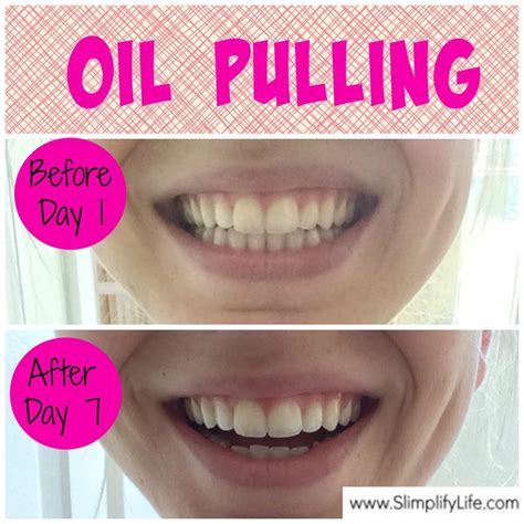 Albums 92 Pictures Coconut Oil Pulling Before And After Full HD 2k 4k