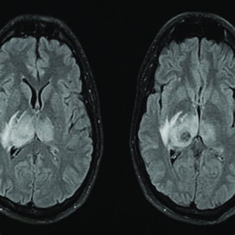 Mri Brain Fluid Attenuated Inversion Recovery Flair Sequence Axial Download Scientific