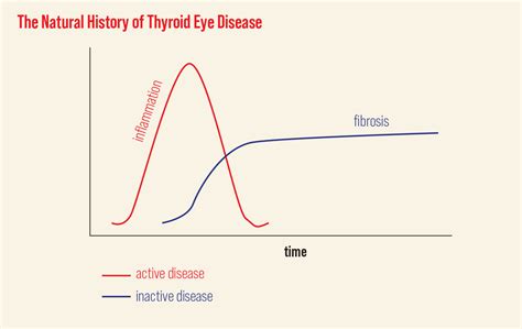 Lesson What ODs Need To Know About Thyroid Eye Disease