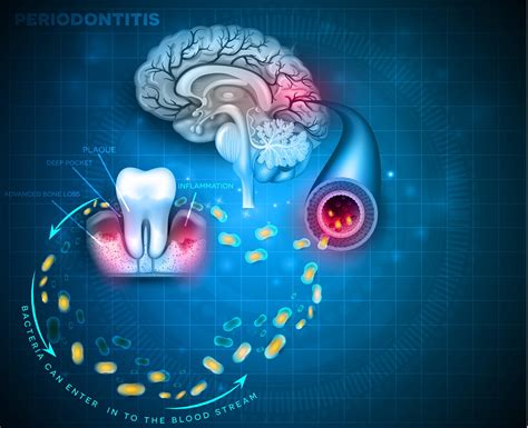 Maladies neurodégénératives quel lien avec la santé buccale