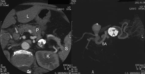 Robot Assisted Treatment Of Splenic Artery Aneurysms Annals Of Vascular Surgery