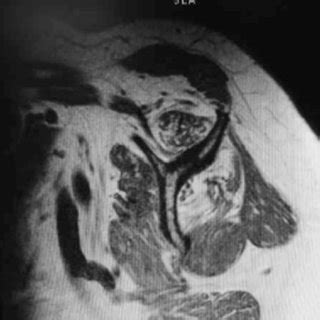 Sagittal T Weighted Magnetic Resonance Image Of Left Shoulder Showing