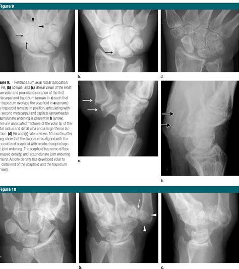 figure   traumatic axial dislocation injuries   wrist