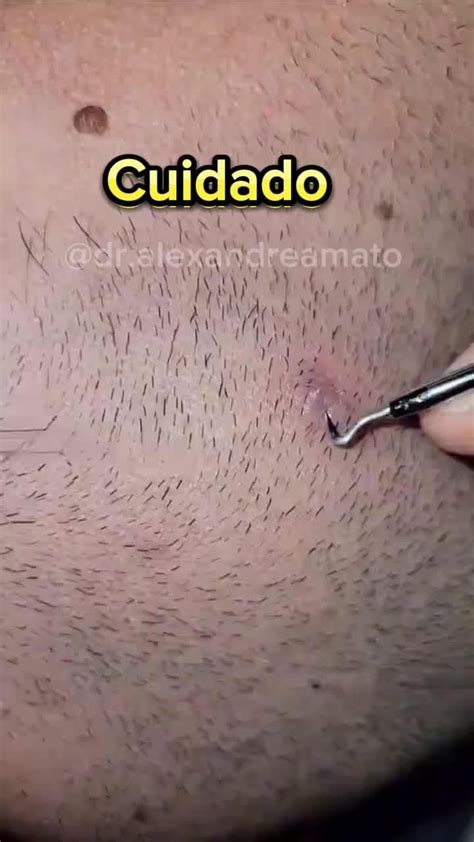 Extraindo Mega Cravo Limpeza De Pele Tirando Cravos E Espinhas