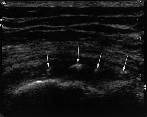 Foci of dystrophic calcification in 49-year-old woman. Transverse ...