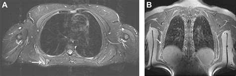 Neurolysis Of The Distal Segment Of The Long Thoracic Nerve For The