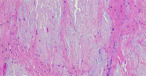 Advances In Care For Patients With Cardiac Amyloidosis Johns Hopkins