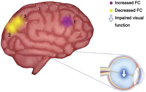 Significant Differences In Spontaneous Brain Activity Between The Nvg