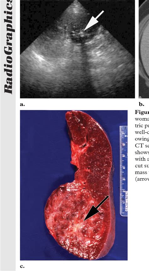 Figure From From The Archives Of The Afip Primary Vascular